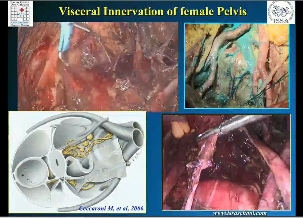 Neuroanatomia pelvica e implicazioni chirurgiche